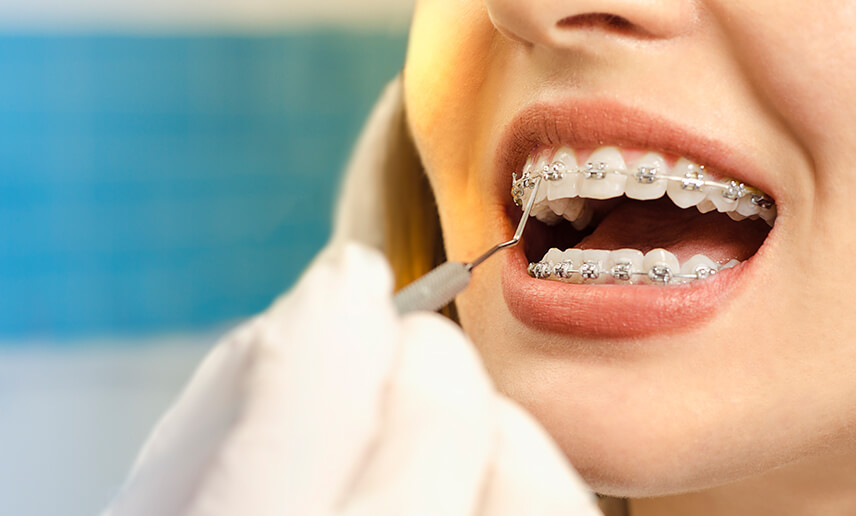 Braces Comfort and Costs in Australia: What to Expect and How We Help