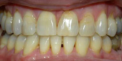 Before & Afters