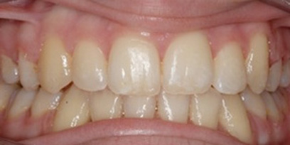 Before & Afters