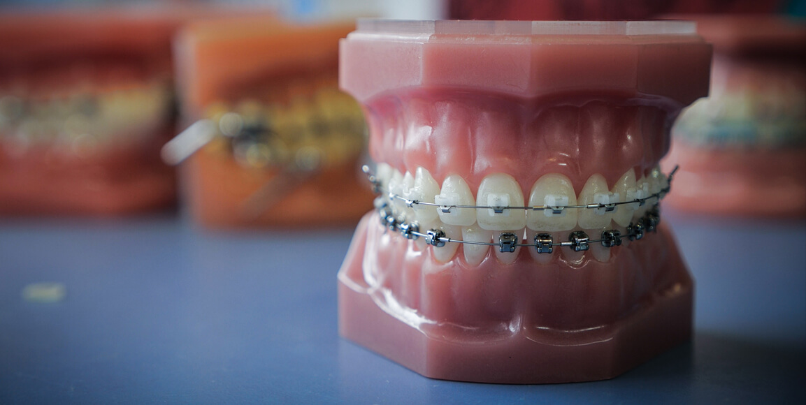 Ceramic braces