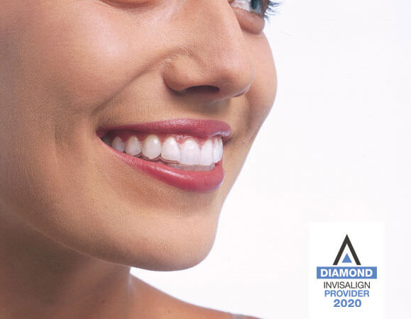 Invisalign Invisalign
